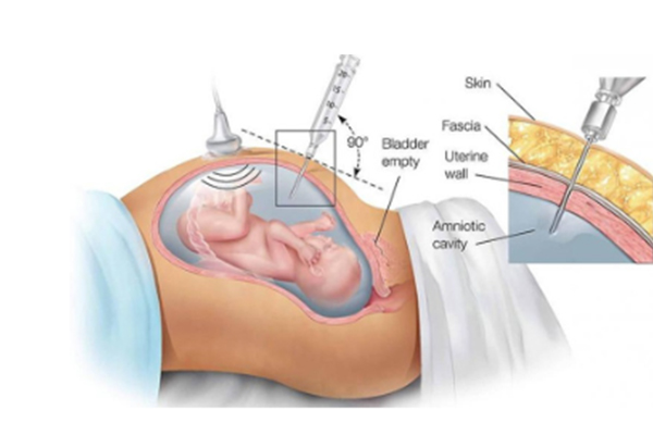 amniocentesis test in bangalore