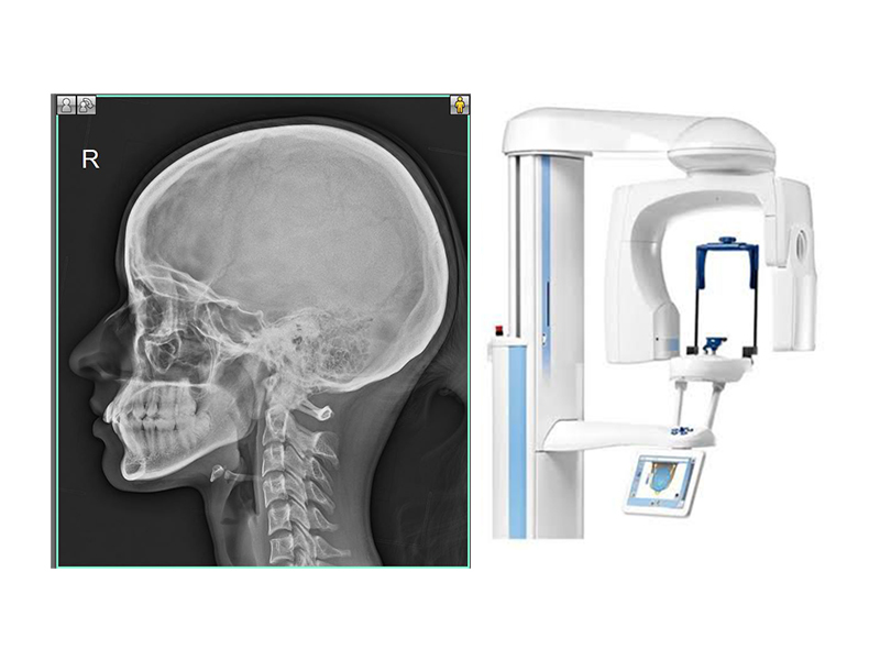 Lateral Cephalogram scan in sarjapur bangalore