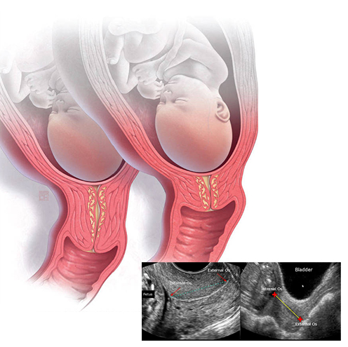 Limited Study for Cervical Length in Bangalore