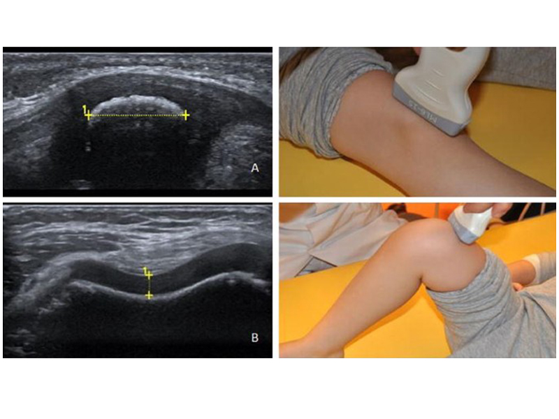 Musculoskeletal Ultrasound in sarjapur marathahalli bangalore