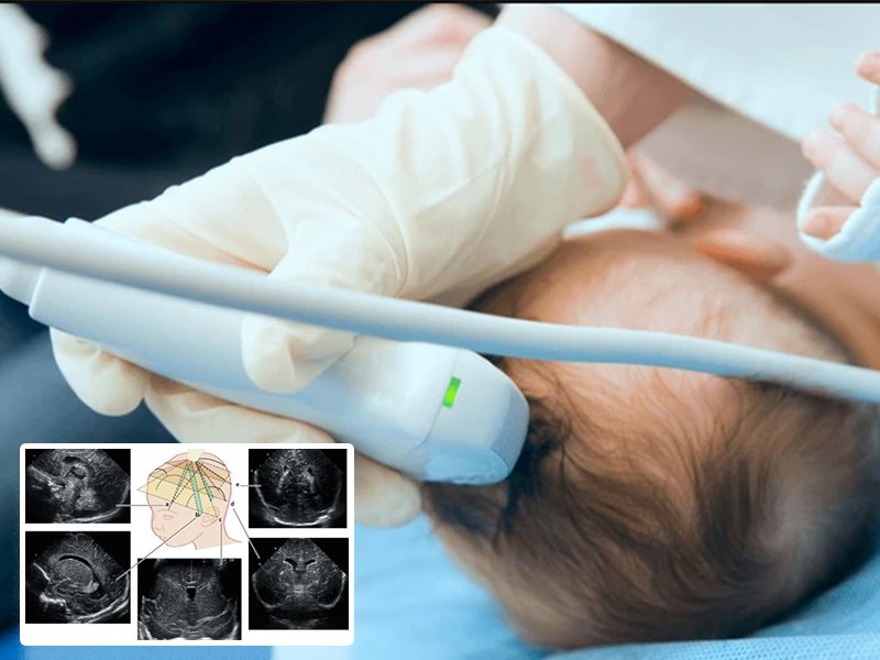 Neurosonogram in sarjapur bangalore