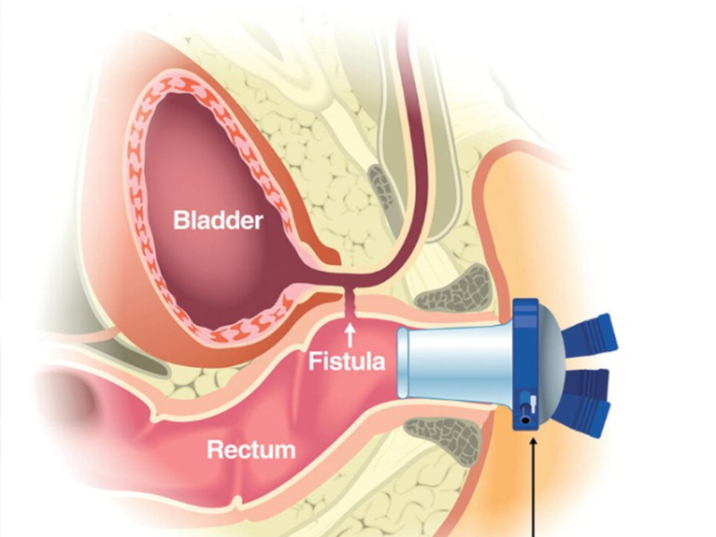 Transperineal Scan in Sarjapur Road Bangalore