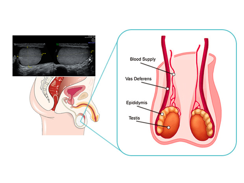 scrotum scan in sarjapur road bangalore