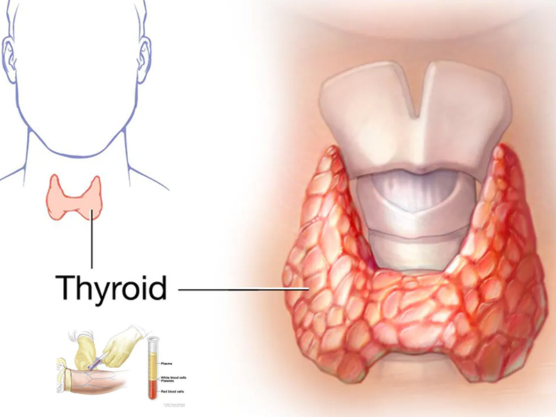 thyroid test in Sarjapur Bangalore