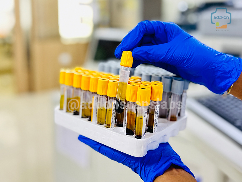 Blood test in Sarjapur