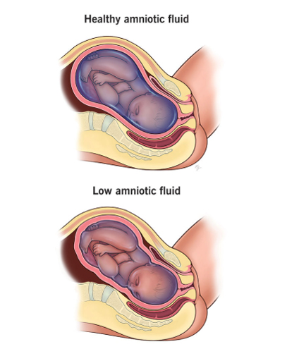 The role of amniotic fluid in pregnancy